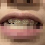 次女の歯の矯正