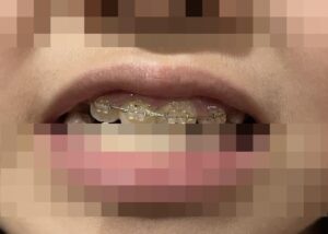 次女の歯の矯正