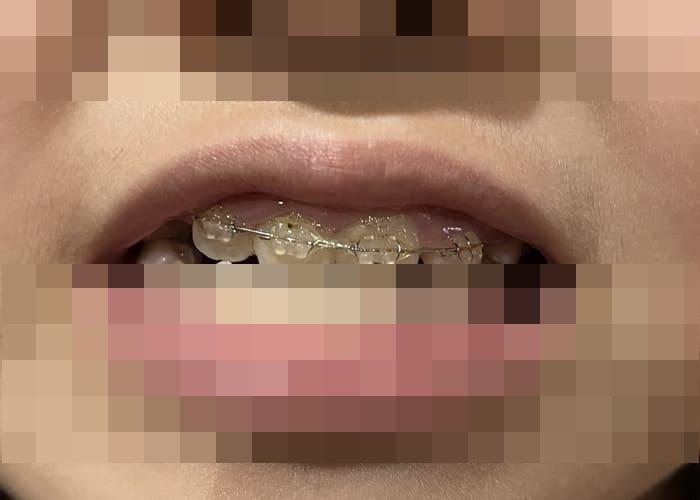 次女の歯の矯正